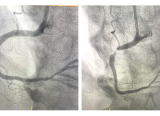 Prevent coronary heart disease through healthy lifestyle choices Prevent coronary heart disease through healthy lifestyle choices