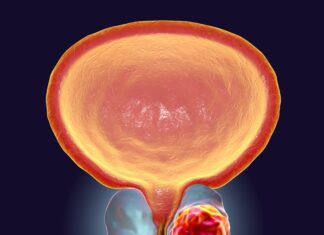 Healthy Diet Reduces Risk of Prostate Cancer Progression Healthy Diet Reduces Risk of Prostate Cancer Progression