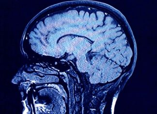 Why brain aging can vary dramatically between people Why brain aging can vary dramatically between people