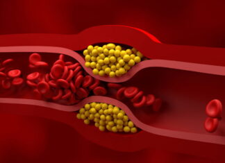 Fluctuating cholesterol in older adults tied to increased dementia risk Fluctuating cholesterol in older adults tied to increased dementia risk