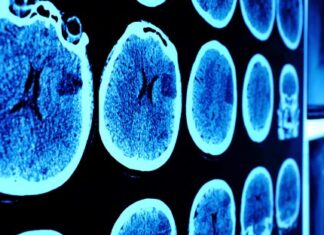 Brain’s ‘blue spot’ key to healthy aging, early Alzheimer’s detection Brain’s ‘blue spot’ key to healthy aging, early Alzheimer’s detection